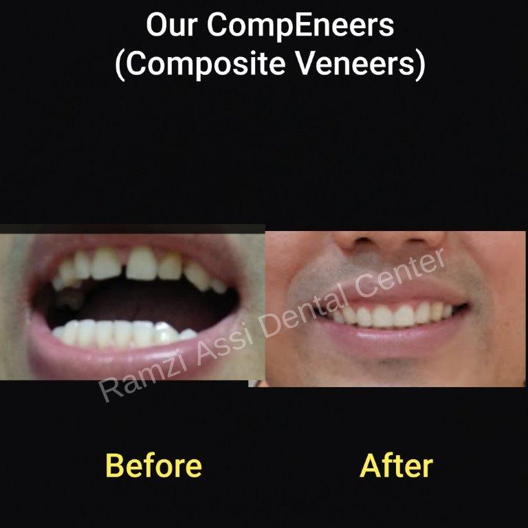 teeth braces